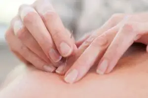 Acupuncturist inserting acupuncture needles into patient's skin