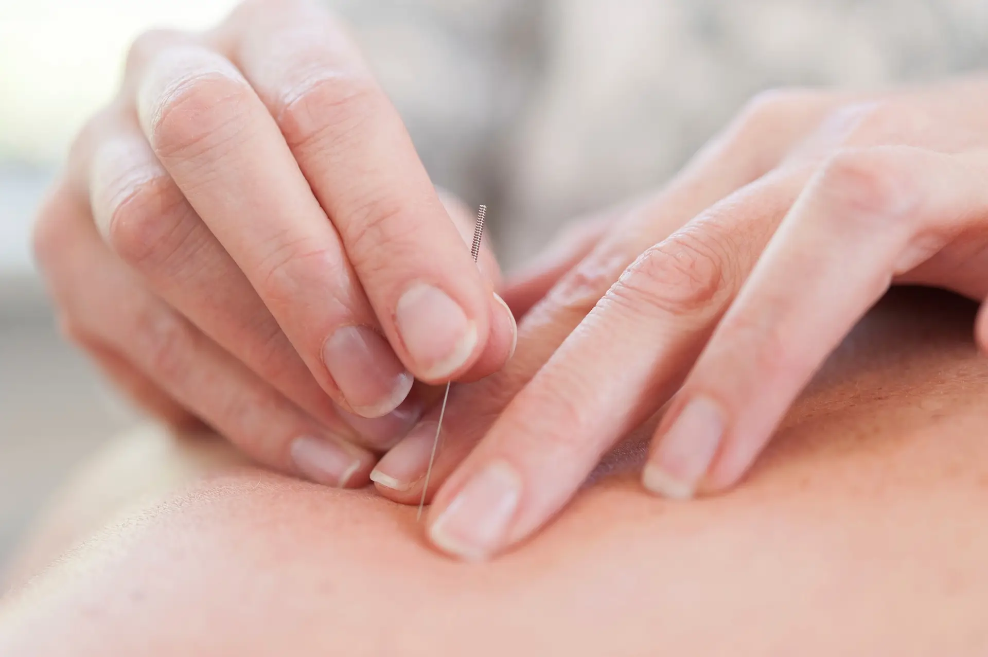 Read more about the article Find Peace and Calm with Acupuncture: Your Guide to Relaxation