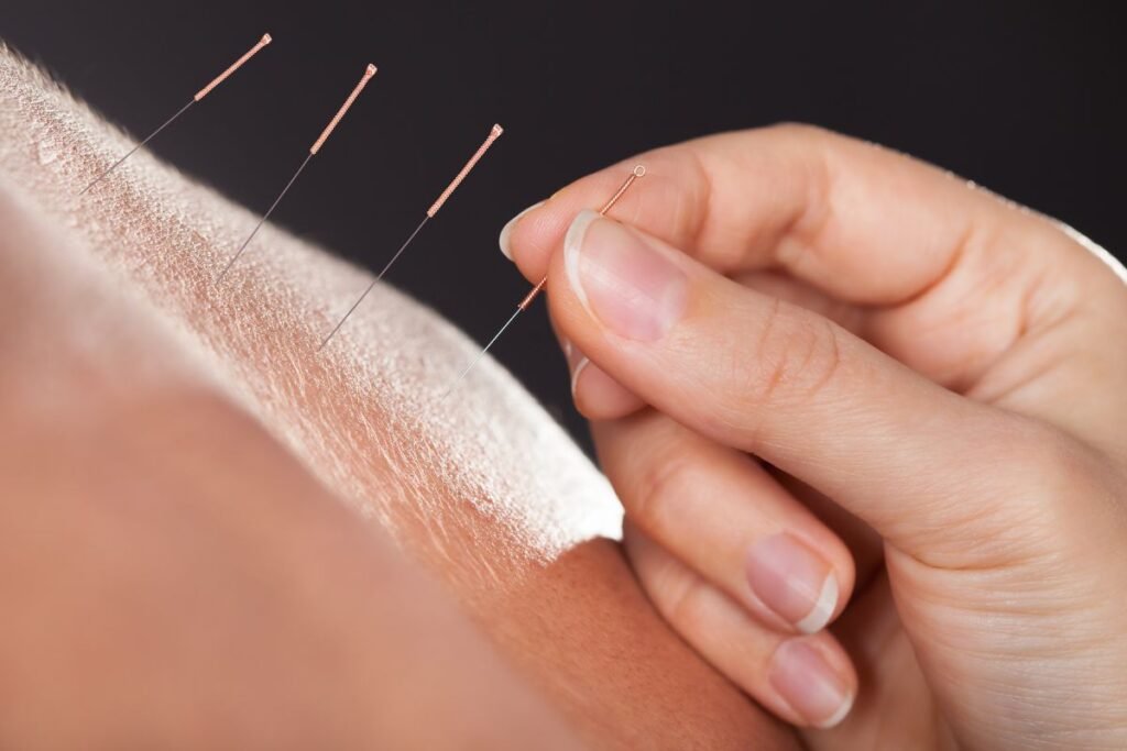 Acupuncture Near Me