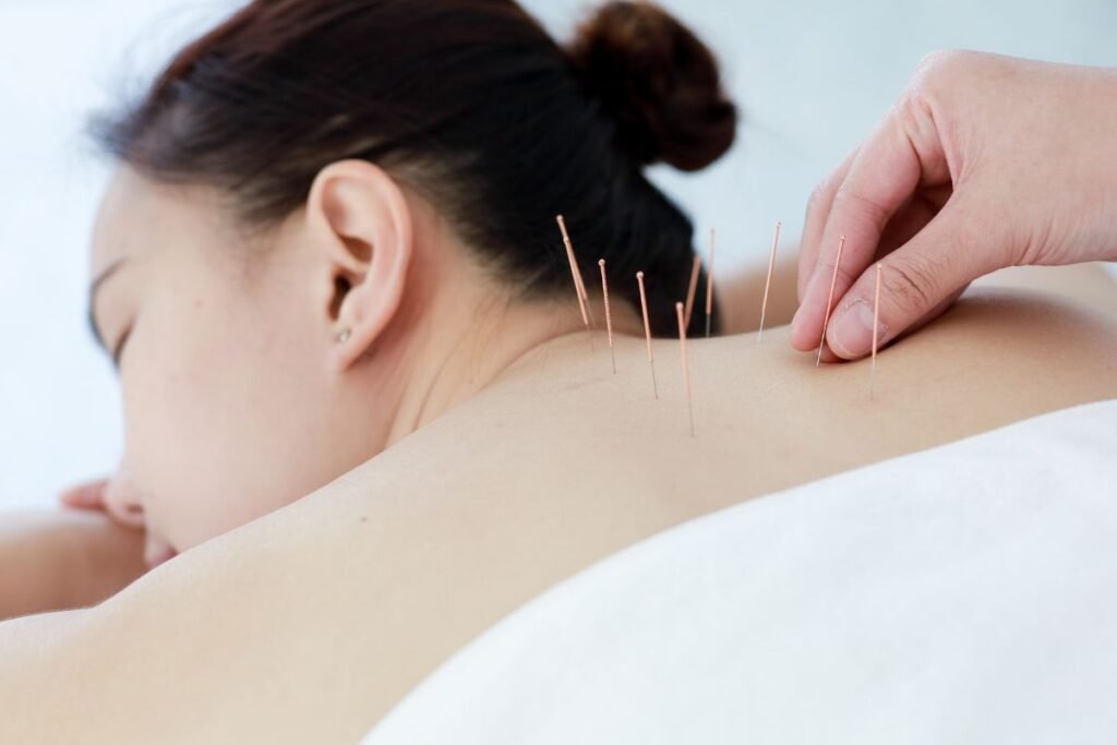 Acupuncture Near Me